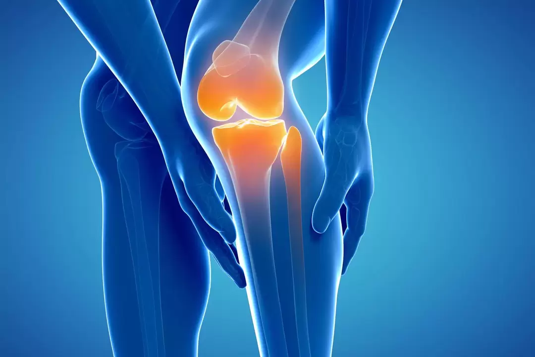 Артроза на коленото зглоб (гонартроза, деформирачки остеоартритис)